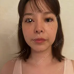 脂肪吸引ラボトウキョウ口コミ