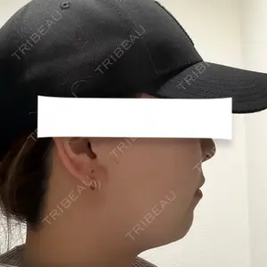 脂肪吸引ラボトウキョウ口コミ