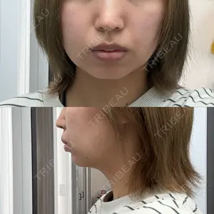脂肪吸引ラボトウキョウ口コミ