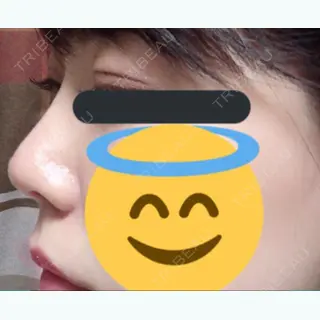 155日目の経過画像（2枚目）