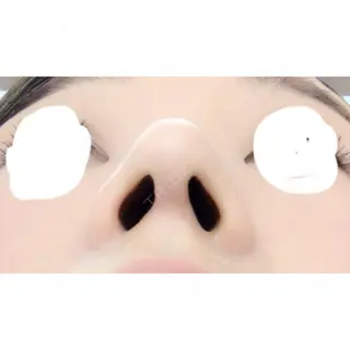 13日目の経過画像（3枚目）