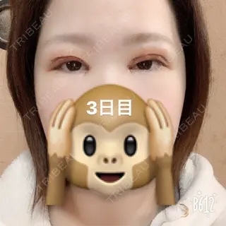 1日目の経過画像（3枚目）