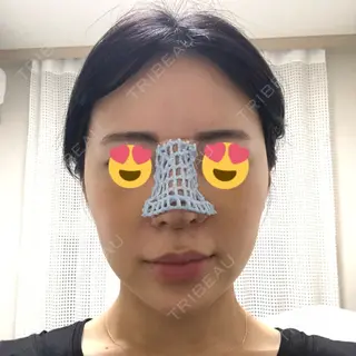 5日目の経過画像（1枚目）
