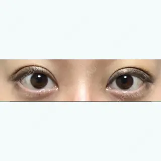 4日目の経過画像（3枚目）