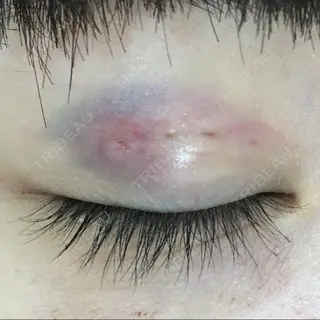 0日目の経過画像（1枚目）