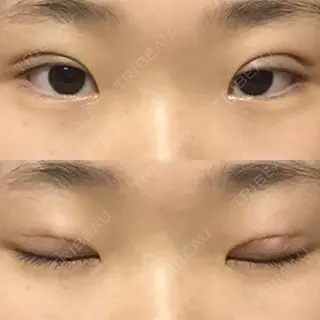 1日目の経過画像（1枚目）