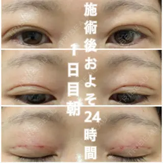1日目の経過画像（1枚目）