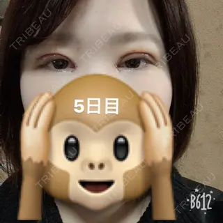 5日目の経過画像（1枚目）