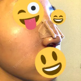 0日目の経過画像（1枚目）