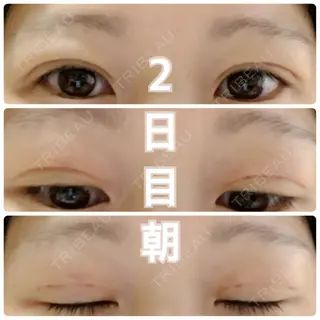 2日目の経過画像（1枚目）