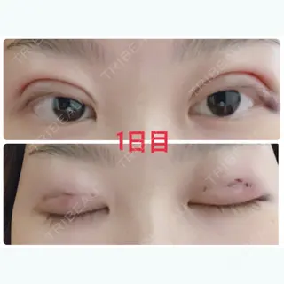 1日目の経過画像（1枚目）