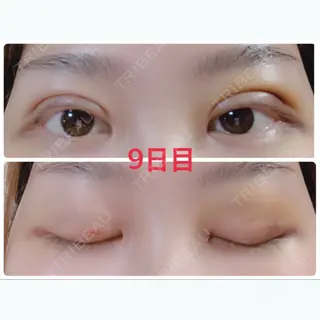 9日目の経過画像（1枚目）