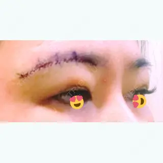 0日目の経過画像（3枚目）