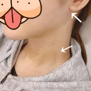 2日目の経過画像（1枚目）