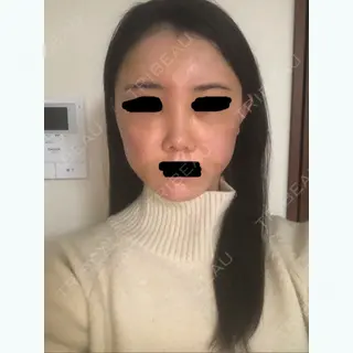 66日目の経過画像（2枚目）