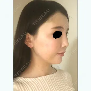 70日目の経過画像（3枚目）