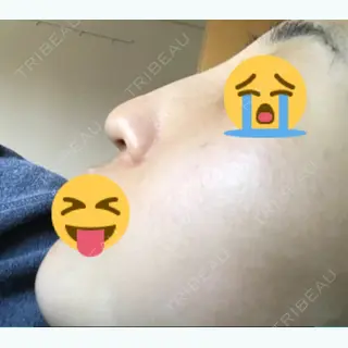2日目の経過画像（3枚目）