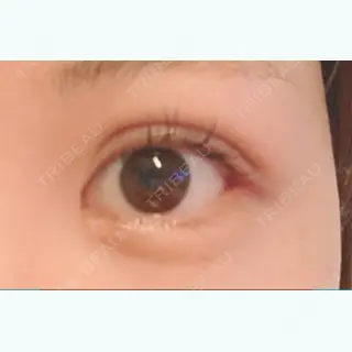8日目の経過画像（3枚目）