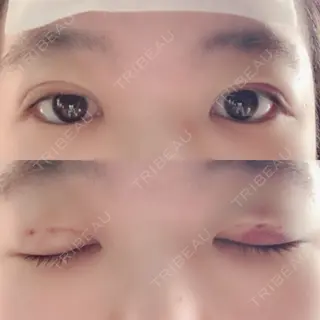 3日目の経過画像（1枚目）