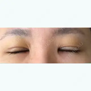 6日目の経過画像（2枚目）