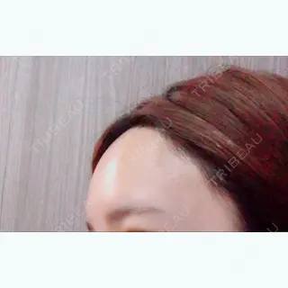 3日目の経過画像（3枚目）