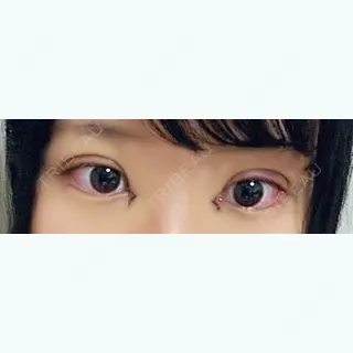 0日目の経過画像（1枚目）