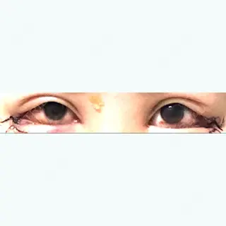 3日目の経過画像（1枚目）