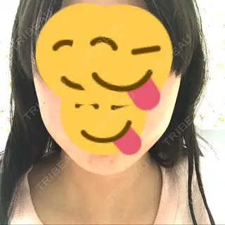11日目の経過画像（1枚目）