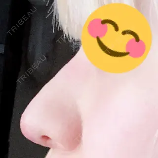 8日目の経過画像（3枚目）