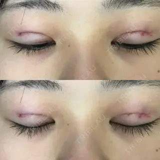 1日目の経過画像（2枚目）
