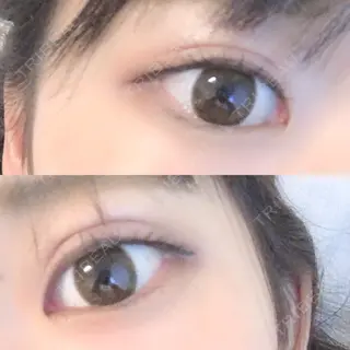 15日目の経過画像（1枚目）