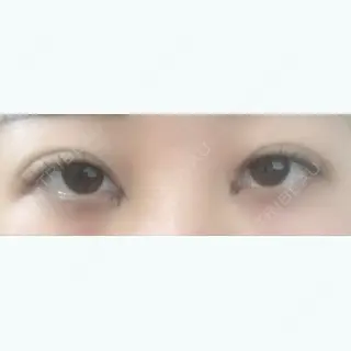 4日目の経過画像（1枚目）