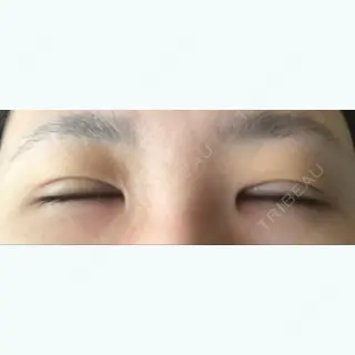 8日目の経過画像（2枚目）