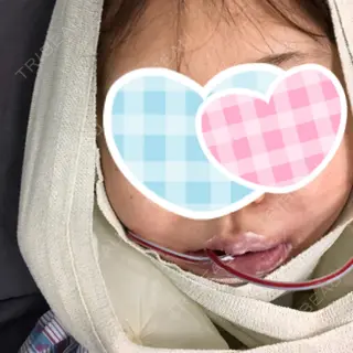 0日目の経過画像（1枚目）