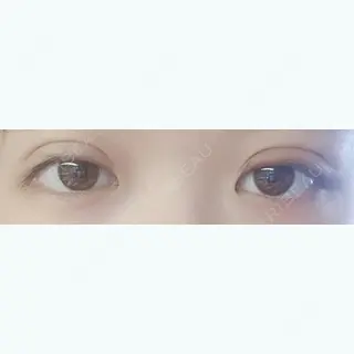 3日目の経過画像（1枚目）