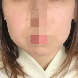 7日目の経過画像（1枚目）