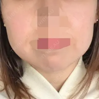 7日目の経過画像（2枚目）