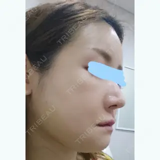 5日目の経過画像（2枚目）