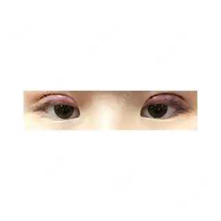 0日目の経過画像（1枚目）