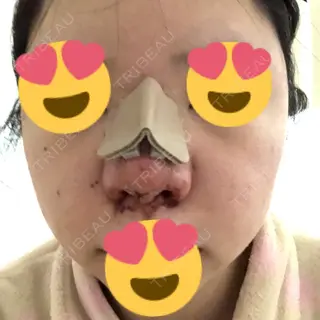 2日目の経過画像（1枚目）
