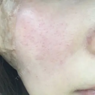 0日目の経過画像（2枚目）