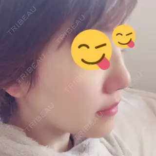 5日目の経過画像（2枚目）