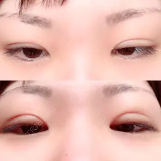 14日目の経過画像（2枚目）