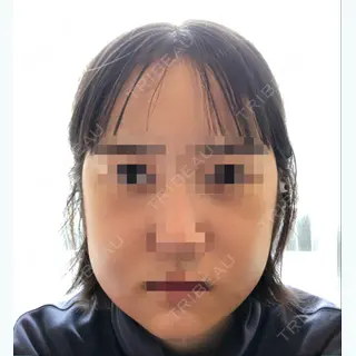 2日目の経過画像（1枚目）