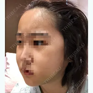 1日目の経過画像（2枚目）