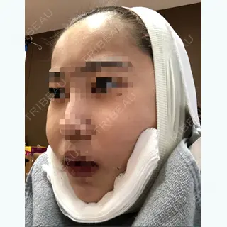 0日目の経過画像（2枚目）