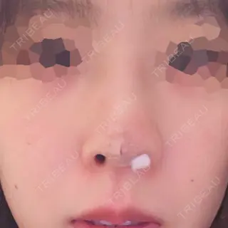 0日目の経過画像（1枚目）