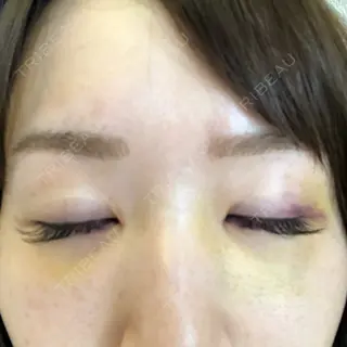 5日目の経過画像（2枚目）