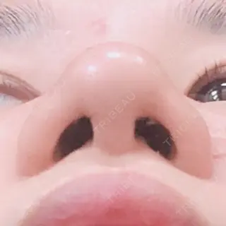 3日目の経過画像（2枚目）