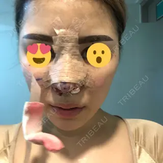 0日目の経過画像（3枚目）